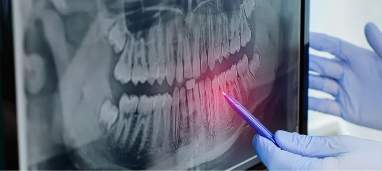 Dentist pointing to an x-ray of teeth